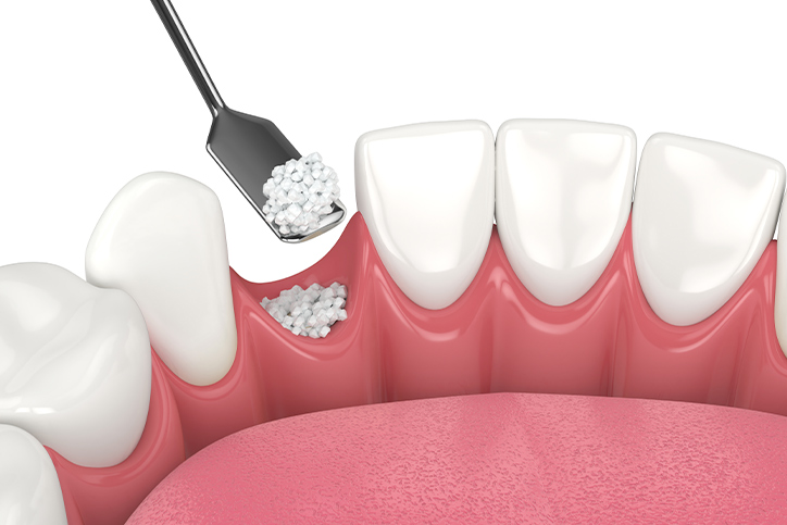Co je augmentace kosti a kdy je potřebná při zubní implantaci?