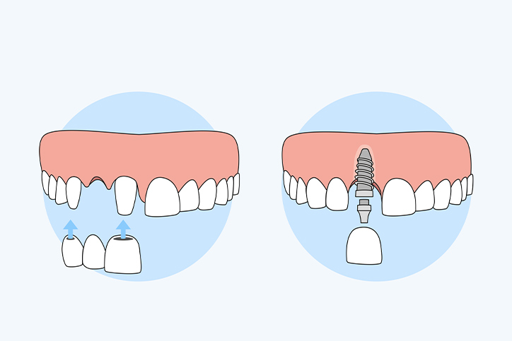 Rozdíl mezi zubními implantáty a zubními můstky