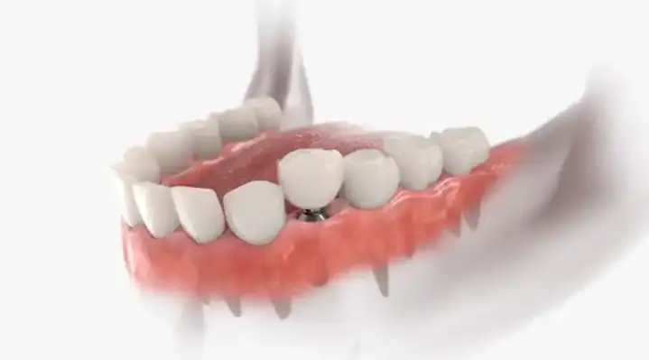 Foto zubního implantátu